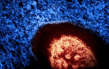 Colourised electron micrograph of a measles virus particle in an archival laboratory image